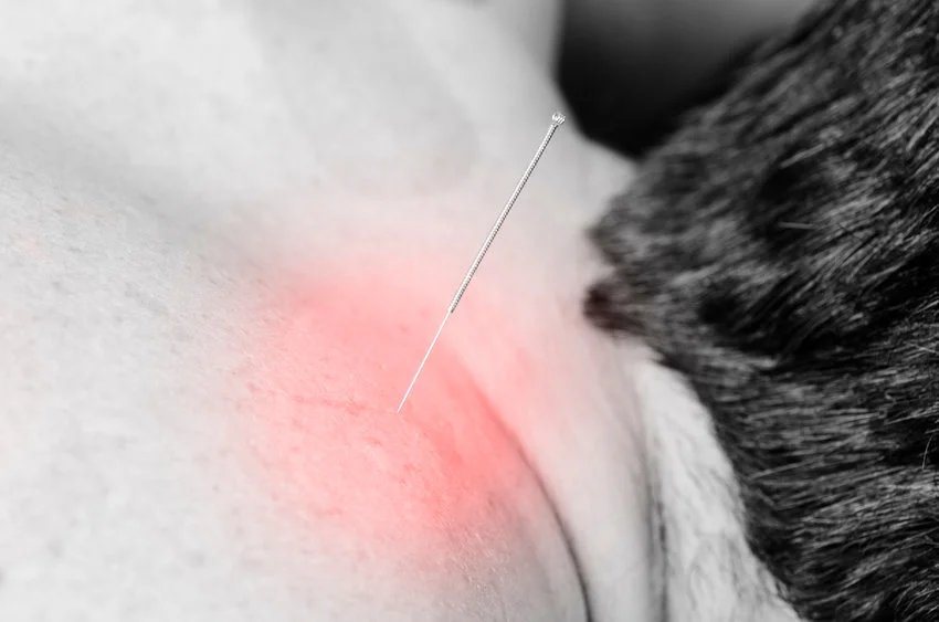 Chiropractors-Newcastle-Dry-Needling