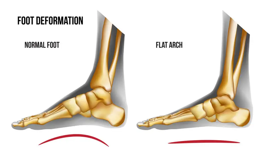 Foot Pronation