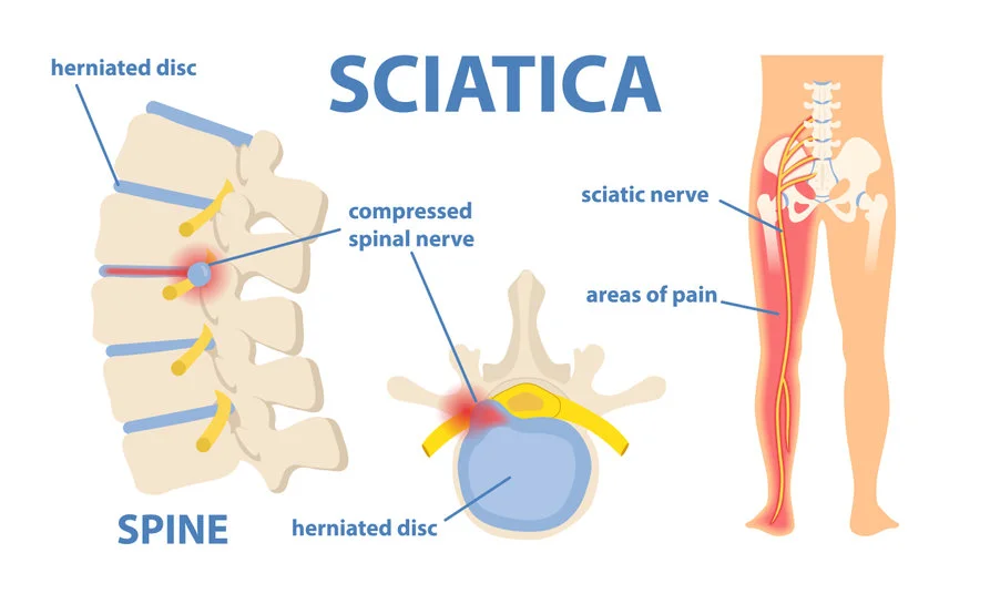 Chiropractors-Newcastle-Sciatica