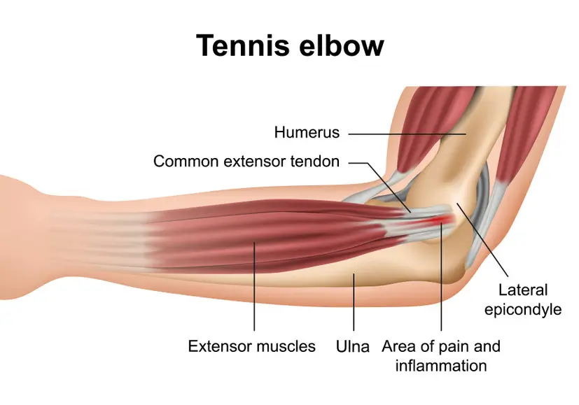 Tennis & Golfers Elbow