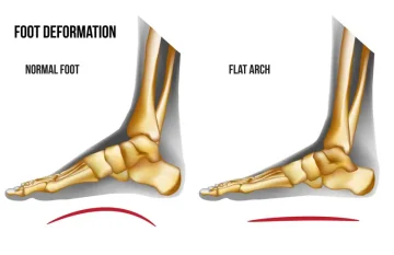 Foot Pronation