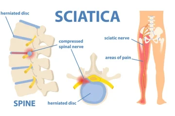 Chiropractors-Newcastle-Sciatica