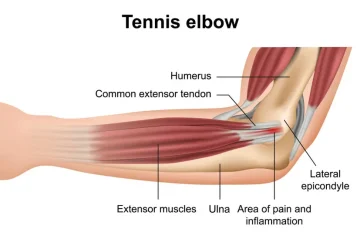 Tennis & Golfers Elbow